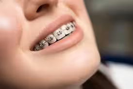 Braces & Aligners